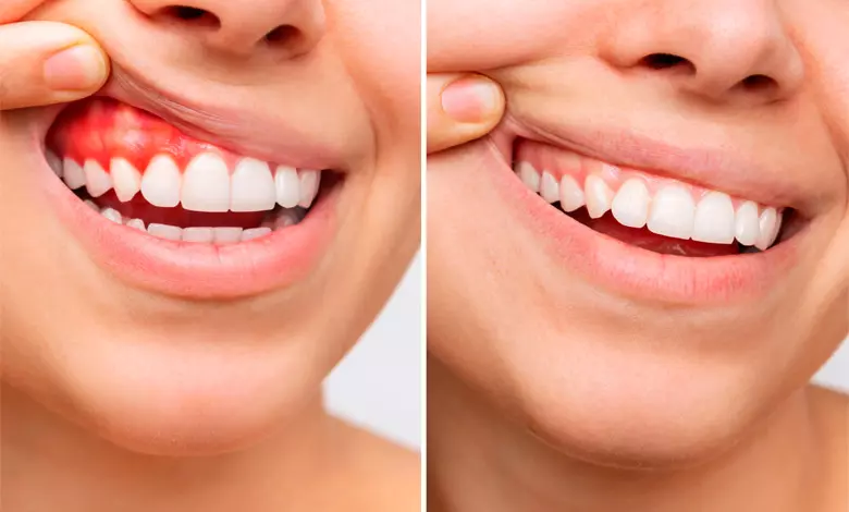 Lentes de Contato Dental: O que é e quanto custa?