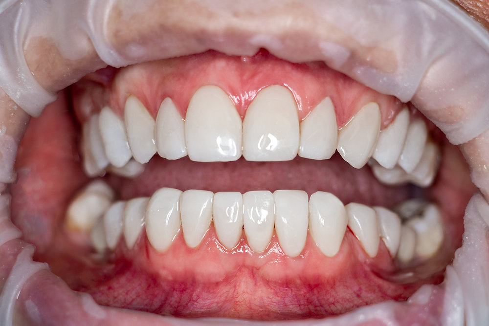 O que não te contam sobre as lentes de contato dental